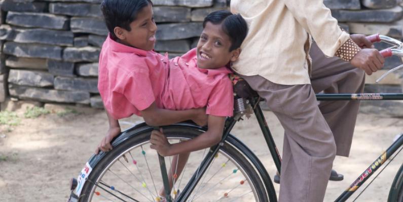 连体人一方去世,假如说有一个连体人去世了