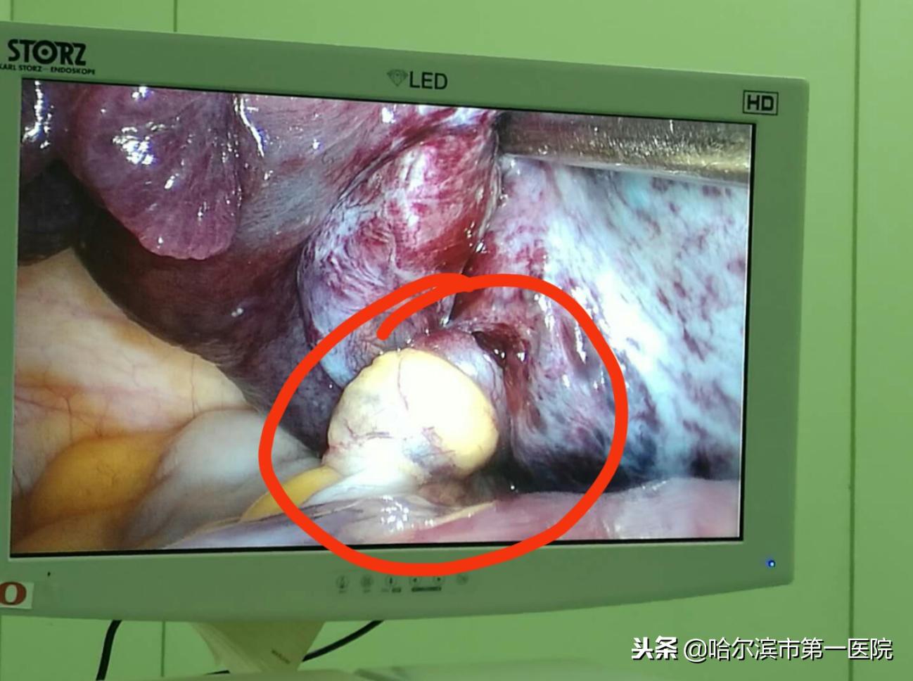 身怀六甲卵巢囊肿蒂扭转720°医生腹腔镜下保母子平安