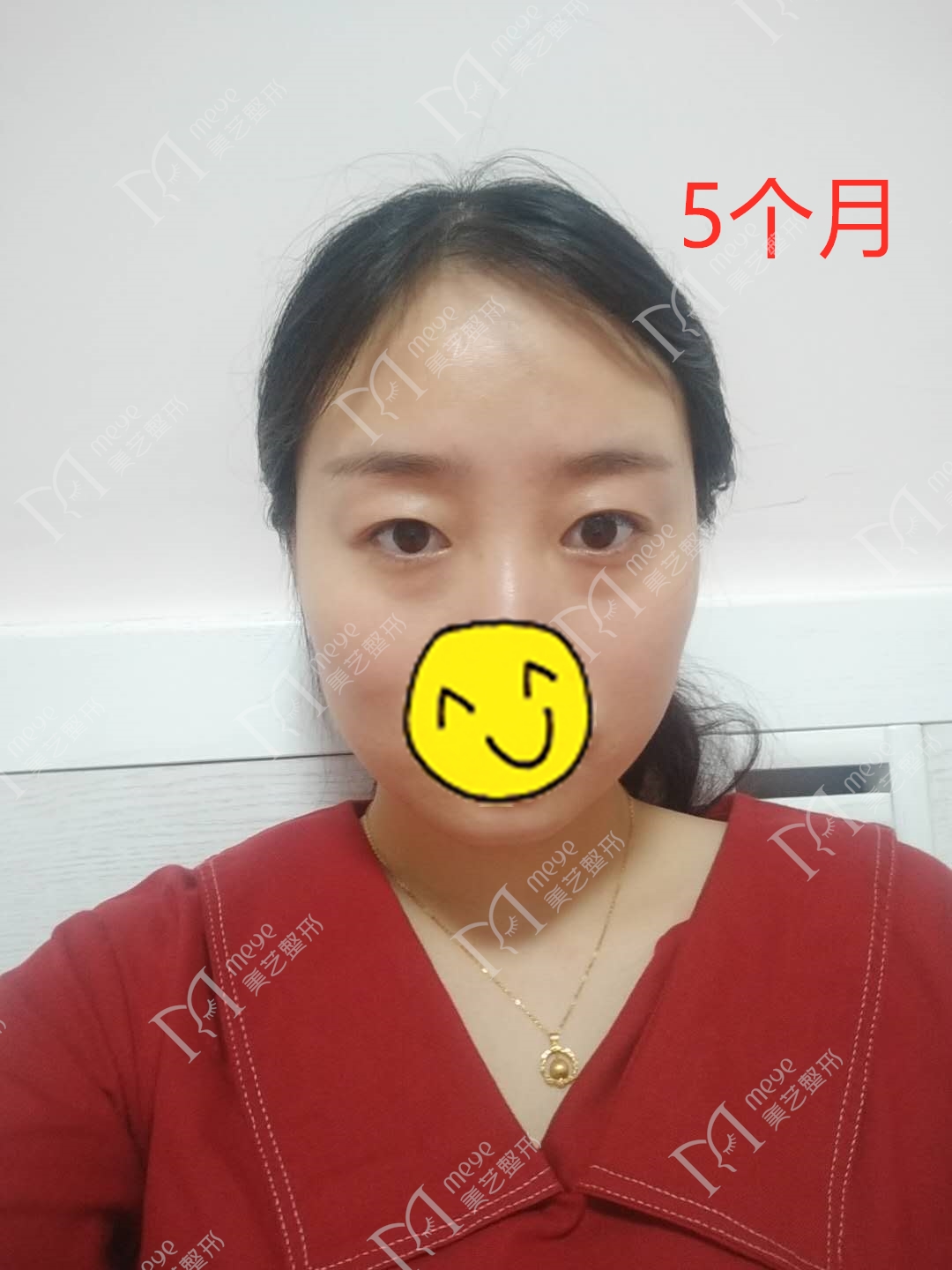 女子双眼皮术后大小眼,大小眼做了双眼皮感觉眼角不对称