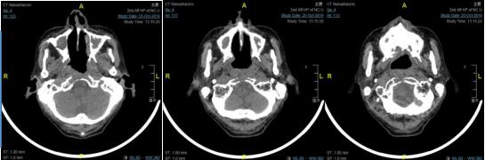 南大二附院耳鼻喉头颈外科在哪,南大二附医院耳鼻喉科一病区