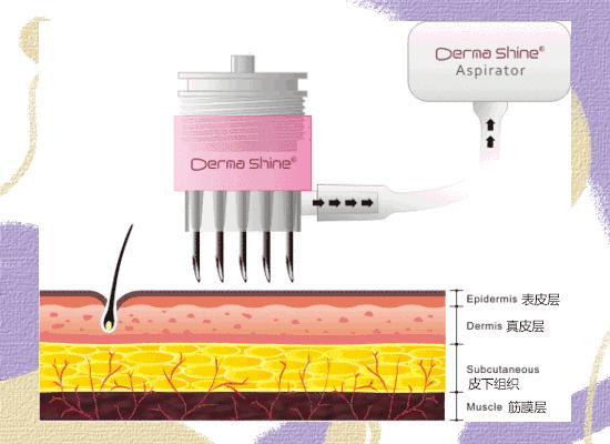 大痘印适合做什么医美,医美做什么可以去除痘坑
