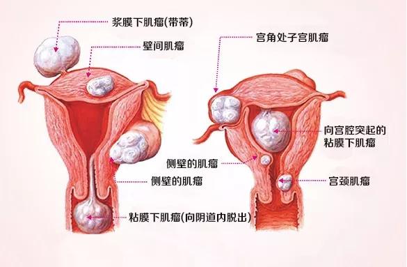 哈医大一院子宫肌瘤专家,子宫肌瘤疾病大全专家解析有声版