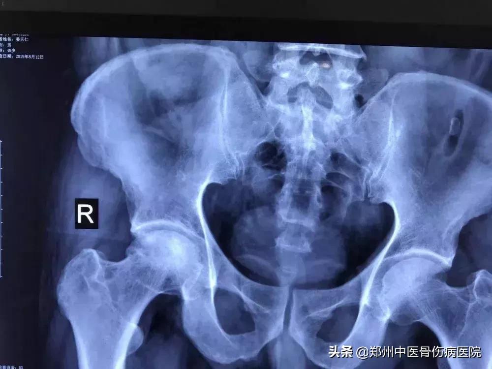 骨坏死是早期治疗好还是晚点治好,骨坏死预后治愈情况