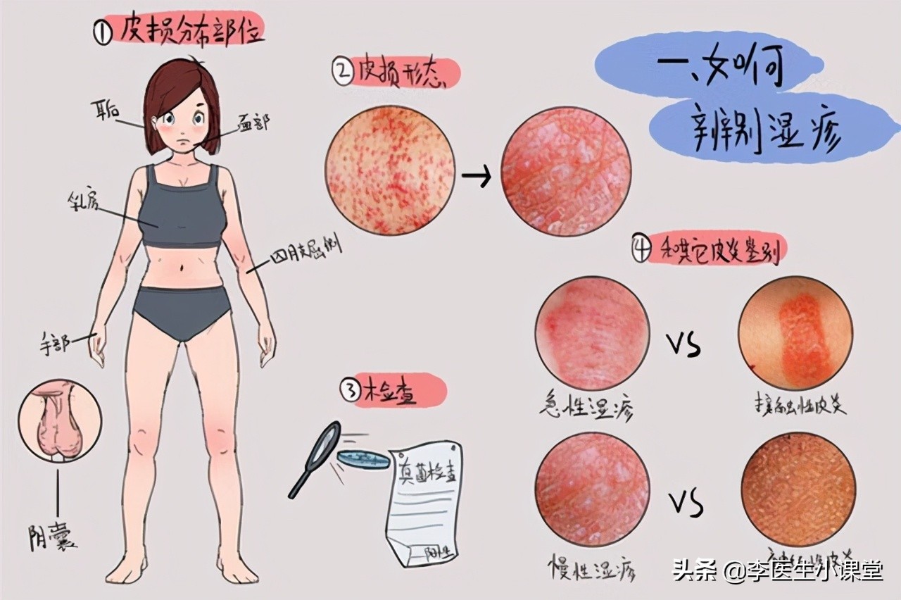 拔罐后罐印上有白点怎么回事,拔罐出现淤青是怎么回事