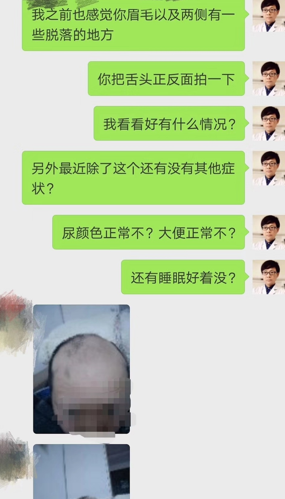 分享一些有什么解决脱发的方法吧,脱发分享