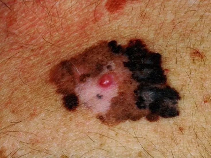 黑色素痣癌变的前兆切除能治愈吗,激光点黑色素痣能诱发恶变吗