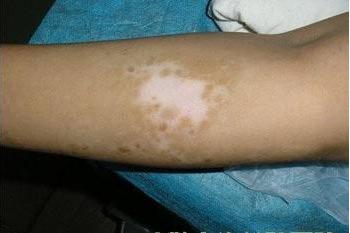 维c对感冒发烧的作用,小孩多吃维生素c变成了白癜风