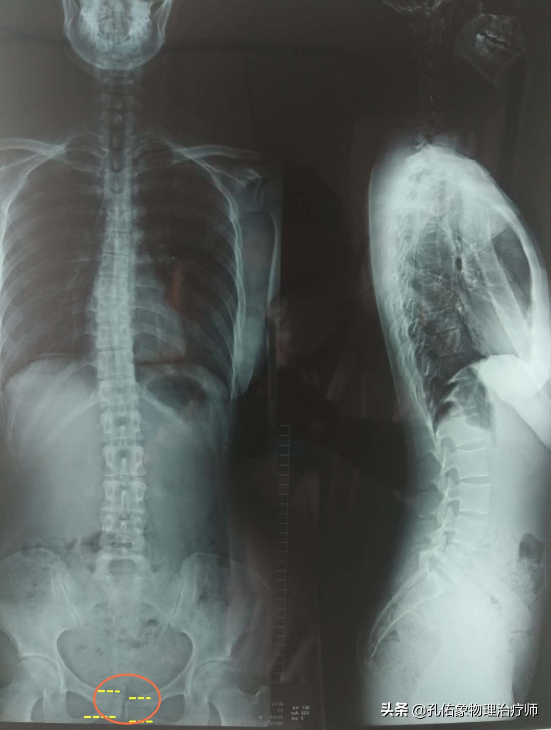 女性为什么大腿根会痛,中年女性大腿内侧疼痛是怎么回事