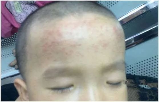 “退热贴”骗了多少中国父母！国内外指南从来没有承认过！​