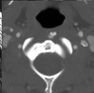 睡醒后脖子酸痛动不了怎么办,睡醒脖子痛不能扭头起身困难