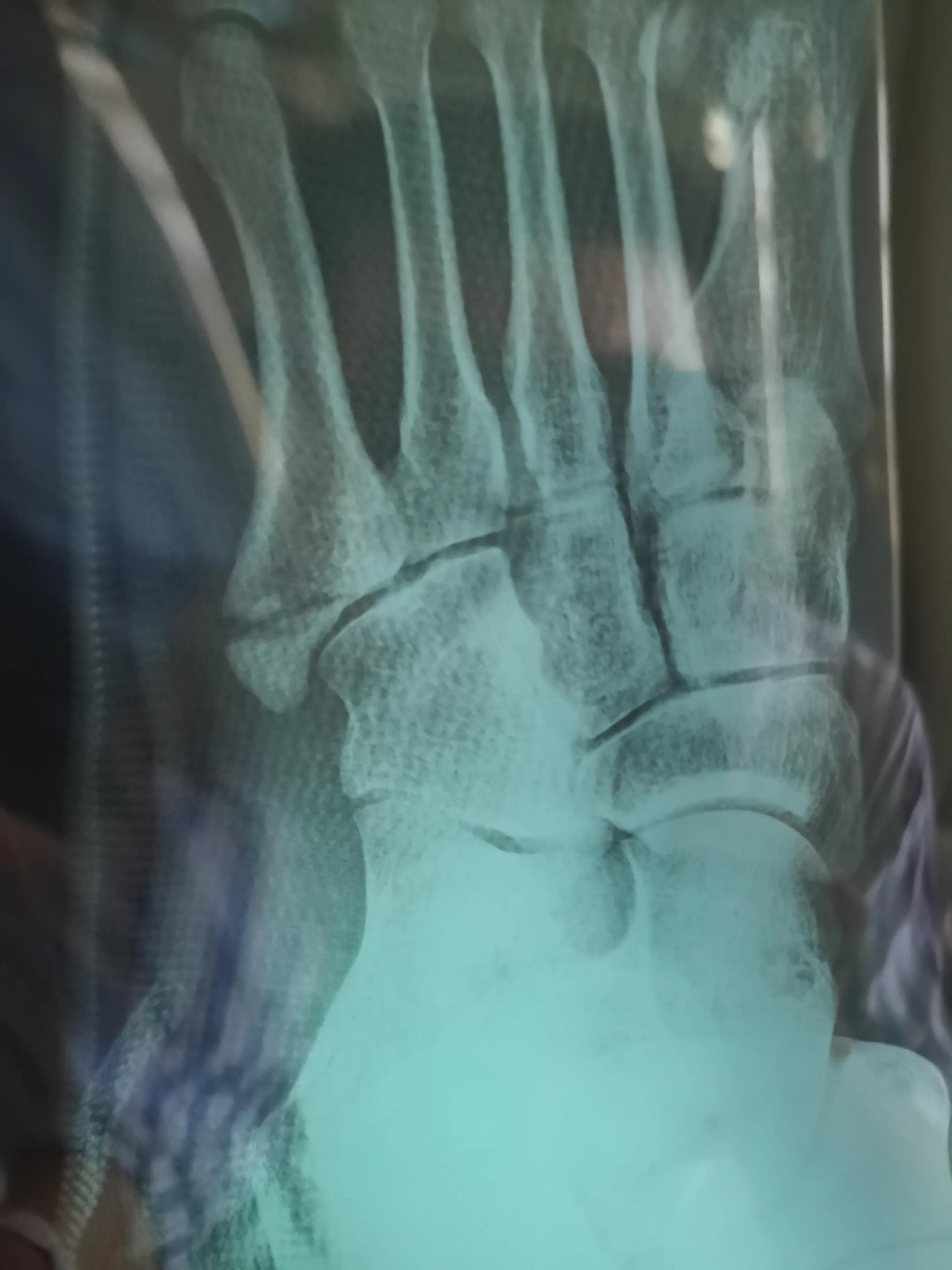 第五跖骨粉碎性骨折多久后能走路,第五跖骨基底骨折100天了走路肿