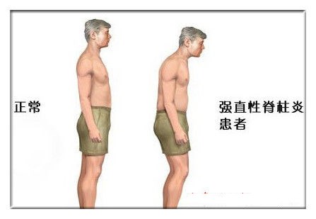 力线平衡术针灸,原始点治疗强直性脊柱炎案例