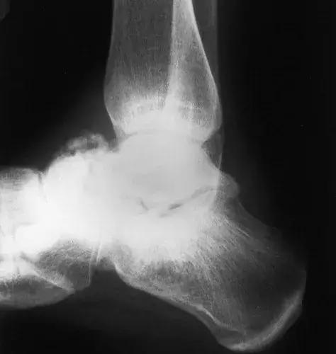 神经性骨关节病,神经性关节炎症状图片