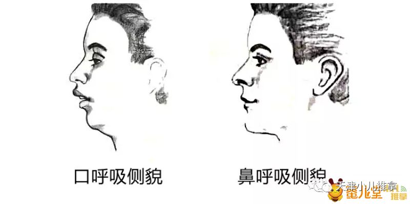 过敏性鼻炎不吃药的老偏方,儿童过敏性鼻炎中医能调理好吗