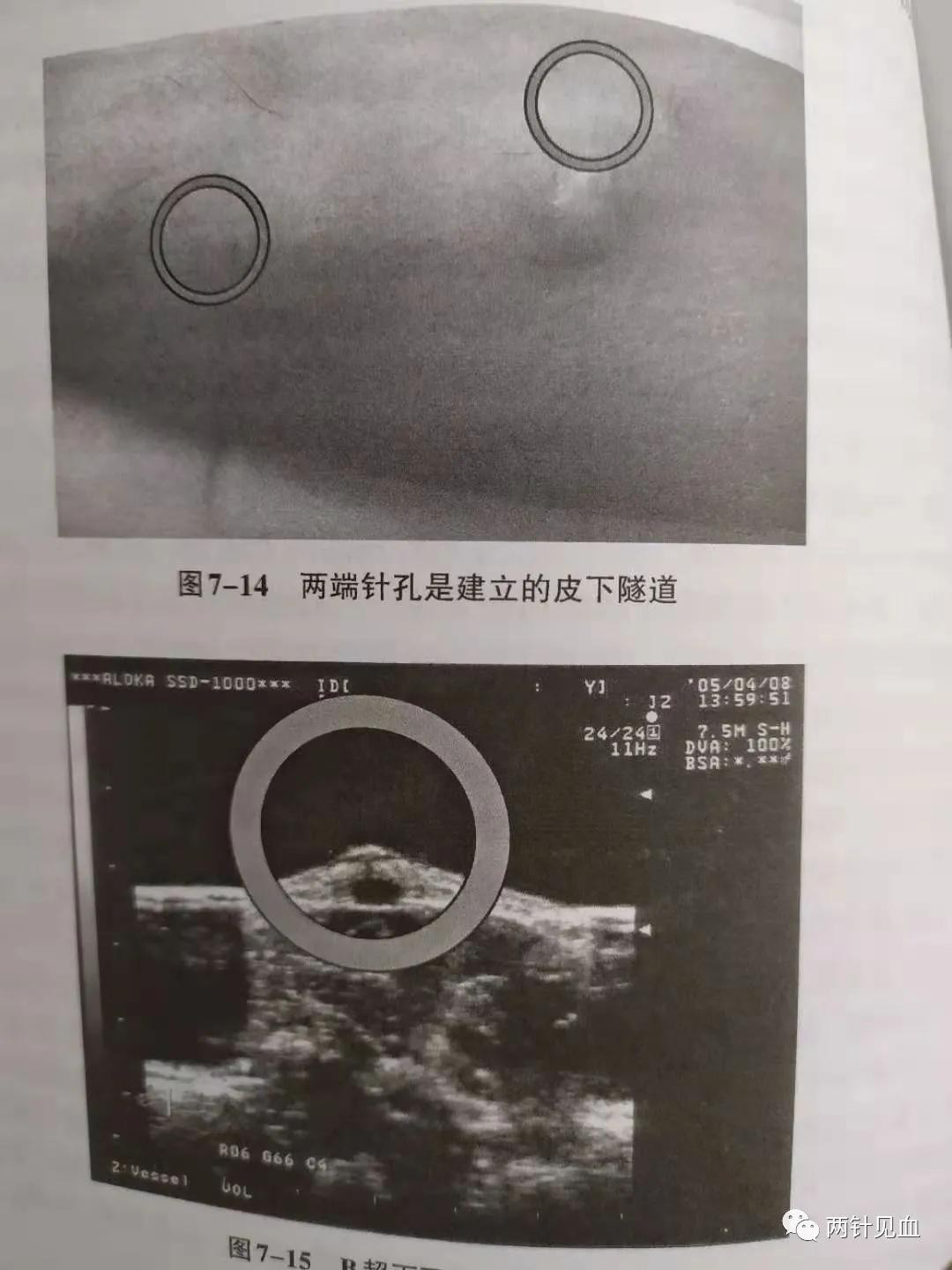 血液透析扣眼穿刺的并发症,血液透析中穿刺针渗血处理流程