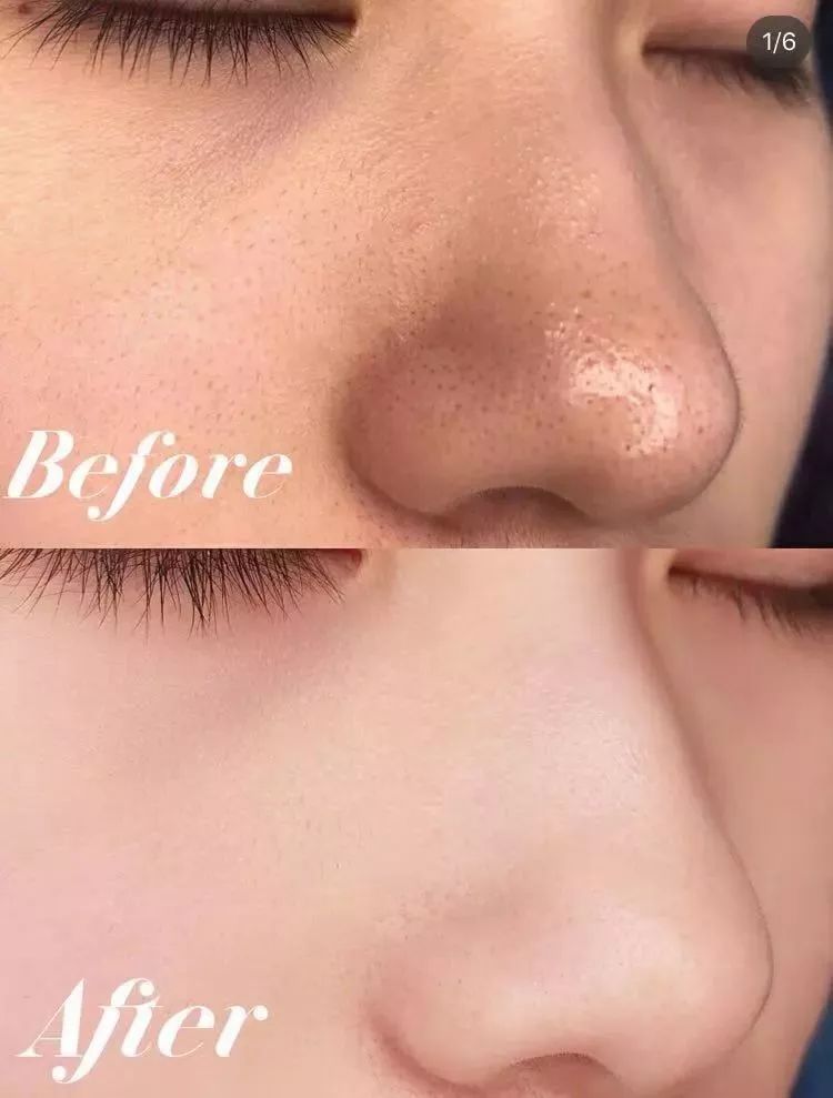 脸上螨虫多出油厉害怎么办,脸上有螨虫痘还痒该怎么办