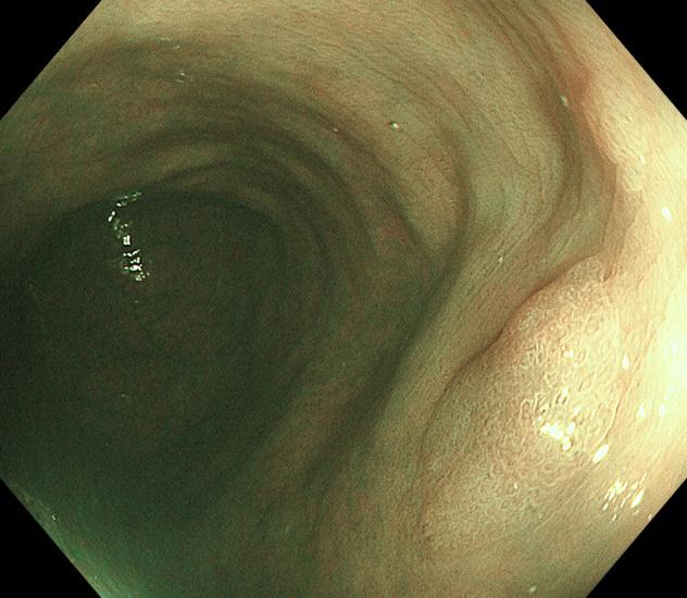胃镜下黏膜剥离手术护理,内镜黏膜下肿瘤剥离术