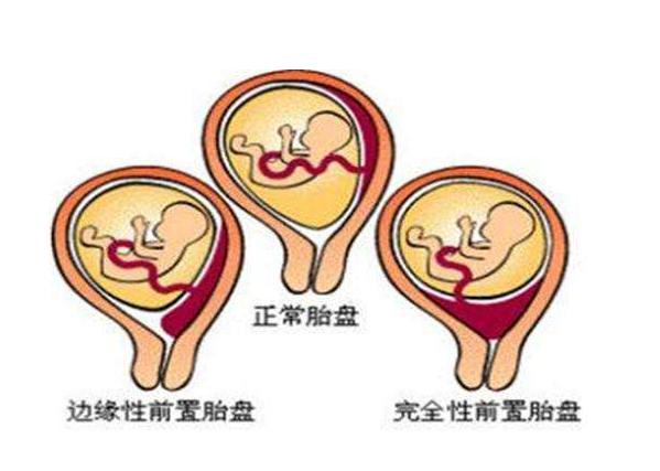 前壁好生还是后壁好生,前壁后壁哪个更容易顺产