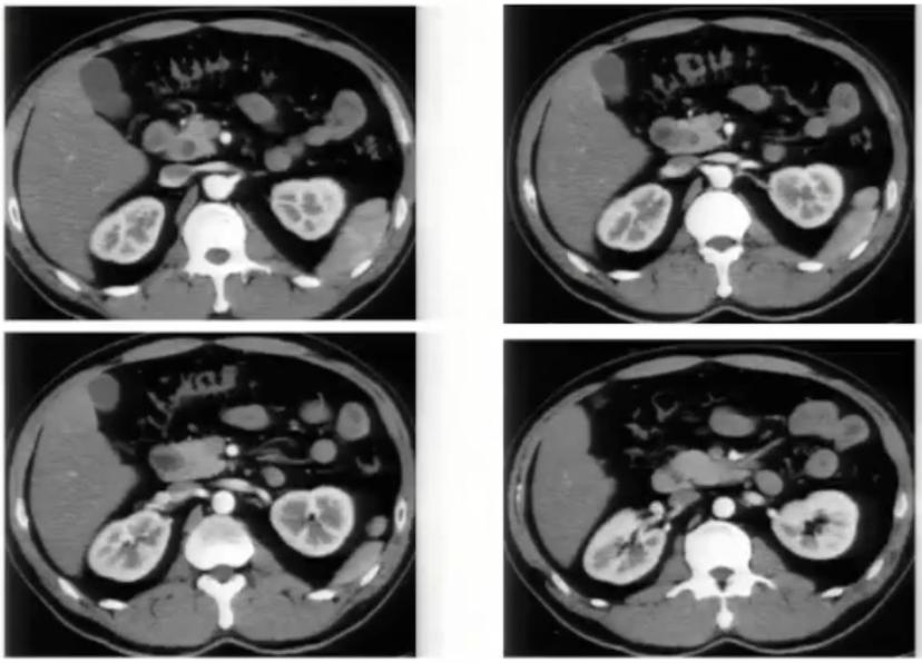 腹部ct详细讲解,腹部ct示意图及超详细教学