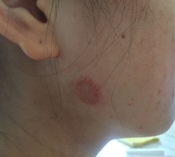 人得了猫癣最简单直接的办法,人治猫癣最简单的方法