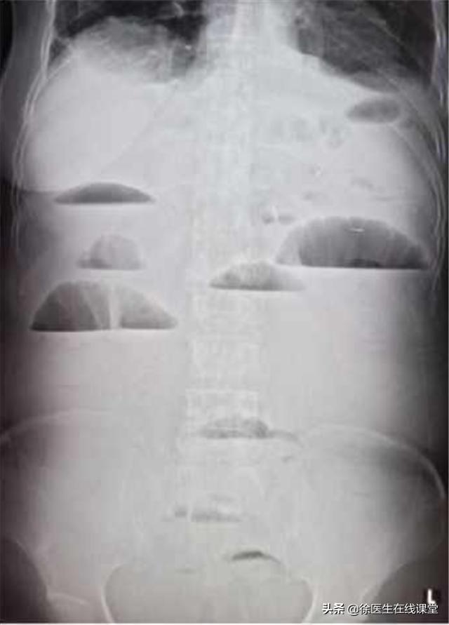 肠息肉到肠癌需要多久？肉眼咋判断是否已癌变？专家为你详细解答