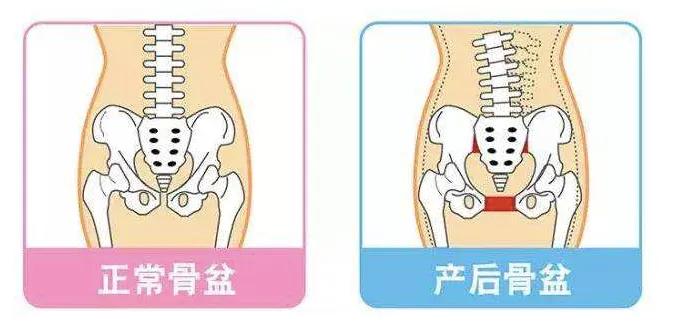 产后腰痛骨盆痛如何缓解,产后妈妈腹部痛怎么回事