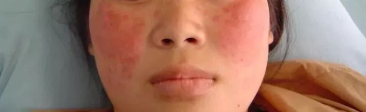 红斑狼疮为何被称为不死的癌症,红斑狼疮不死的癌症