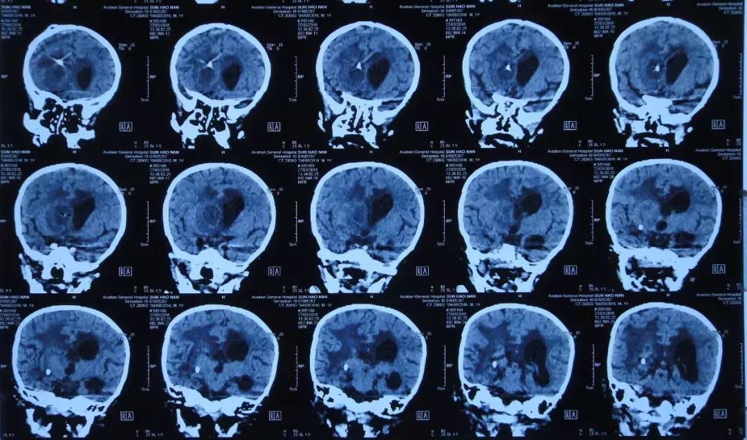 孩子脑积水反复发烧,婴儿脑积水引起发烧如何保守治疗