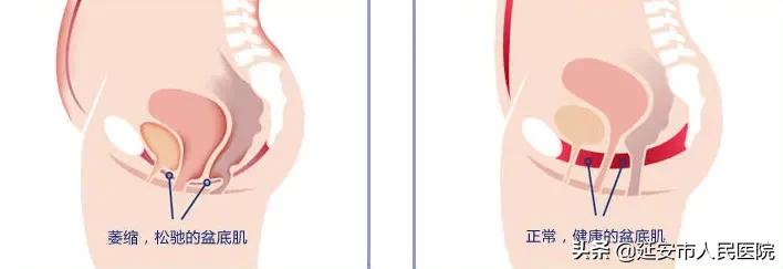 延安市人民医院妇产科李爱明主任“盆底整复”专病门诊开诊啦