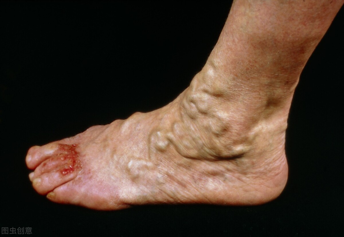 腿上像蚯蚓一样的血管是怎么回事,腿上的血管像红线一样