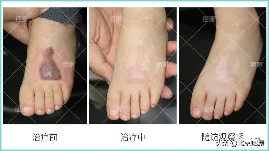 孩子烧伤疤痕，单纯预防多长时间能看到效果？