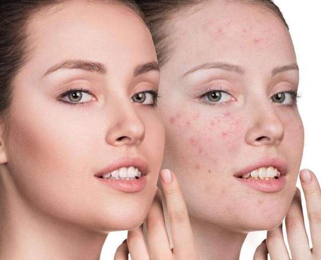 痘痘反复发炎怎么办,痘痘肌反反复复怎么改善