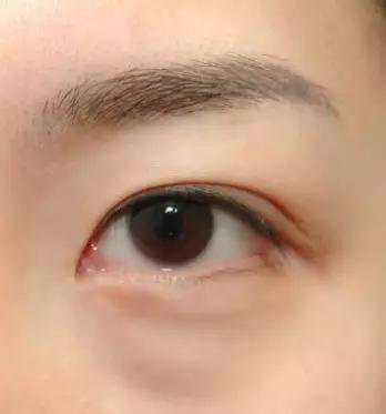 困扰千万姑娘的眼袋,究竟该怎么办