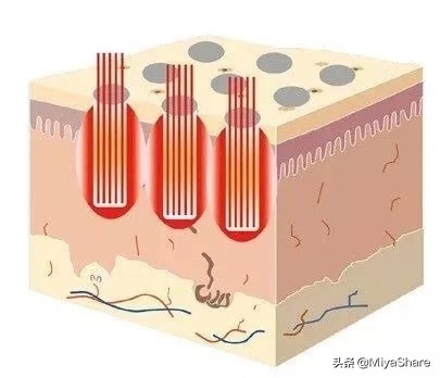 脸上痘坑痘印用什么方法修复,满脸痘坑疤痕怎么去除