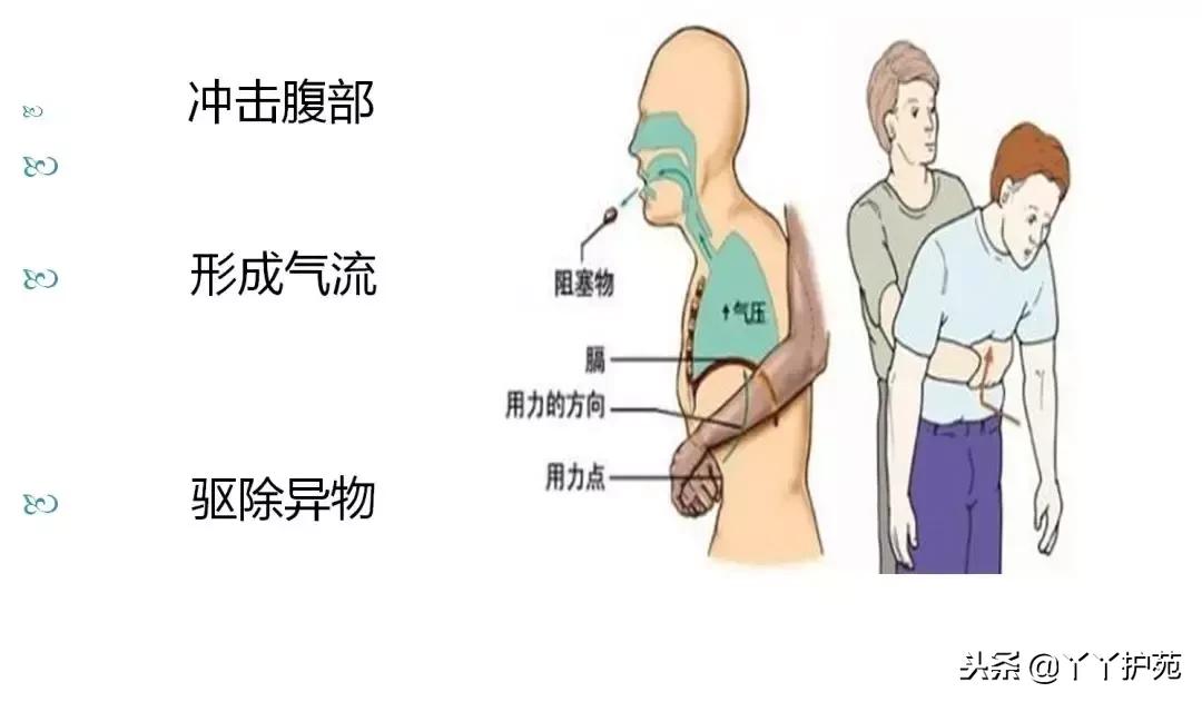 大人气管异物急救法操作过程,婴幼儿气管异物堵塞的急救处理