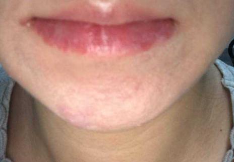 下巴反复长闭口粉刺怎么饮食,下巴反复长痘闭口粉刺用什么药膏