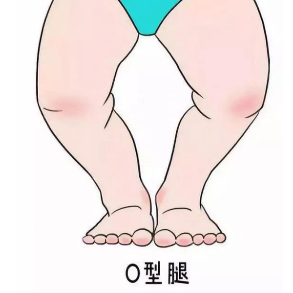 孩子o型腿可以自己绑腿吗,新生儿可以通过绑腿预防o型腿吗