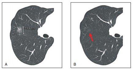 肺CT报告中的肺结节GGO是什么东西？到底是不是癌？