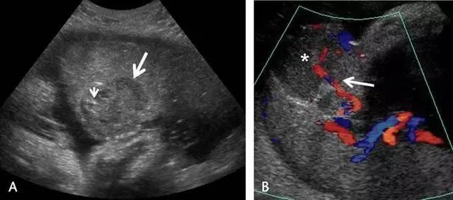 临床上最常见的异常胎盘,前置胎盘和低置胎盘超声