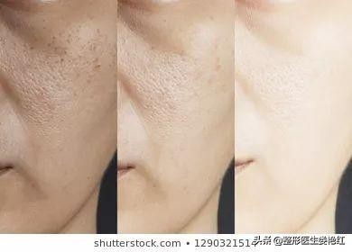 刷果酸可以祛黑头吗,去闭口粉刺黑头果酸产品推荐