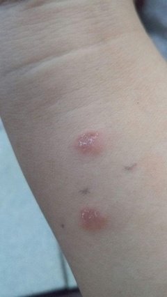 猫癣反反复复的长是怎么回事,猫癣反反复复怎么办