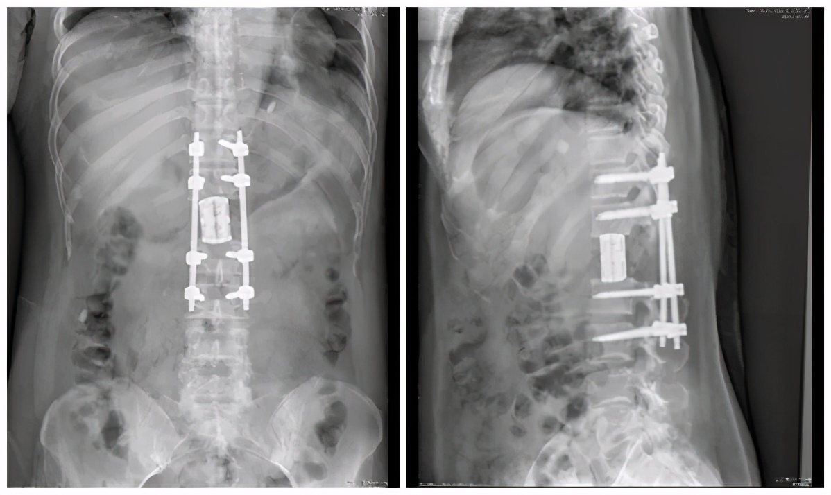 文登整骨医院脊柱微创手术怎么样,文登整骨脊柱微创