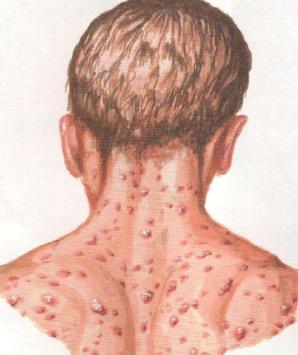 皮肤3种情况警惕艾滋病,有一种病比艾滋病还要可怕