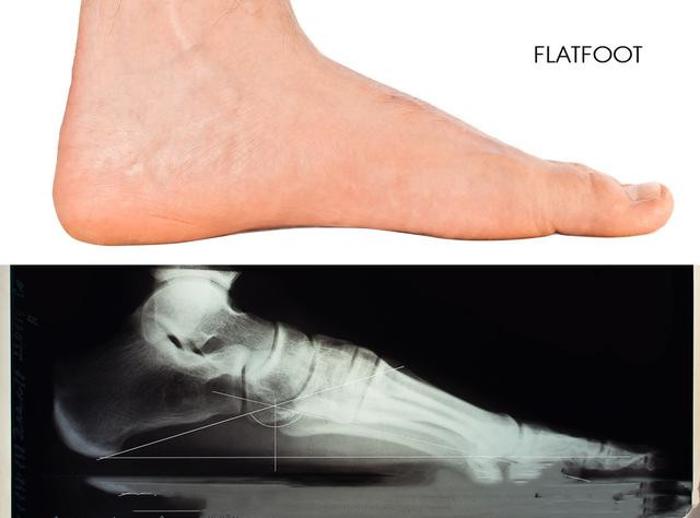 穿哪种鞋子更容易得扁平足,扁平足穿鞋难看怎么办