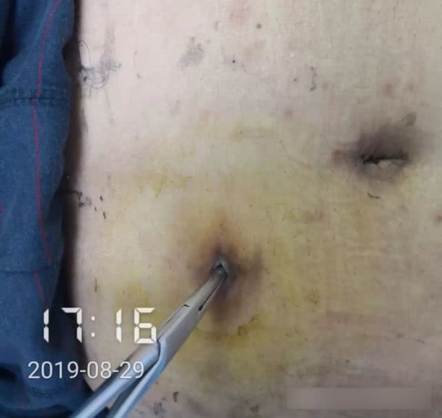 阑尾炎形成窦道的原因,阑尾炎一孔微创手术全过程