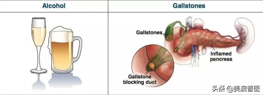 吃海鲜容易得胰腺炎,胰腺炎是胡吃海喝造成的吗
