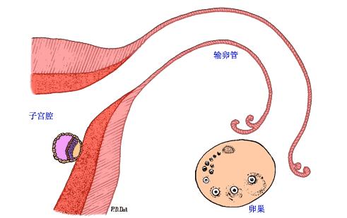 3次宫外孕保守治疗,宫外孕3次怎么办