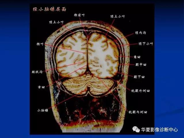 电子版头颅ct与mri断层解剖,头颅mri血管解剖与分段详解