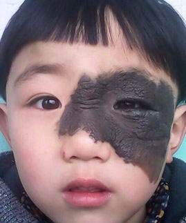 黑毛痣怎么治疗效果才好呀,专家告诉你黑毛痣的治疗最佳时间