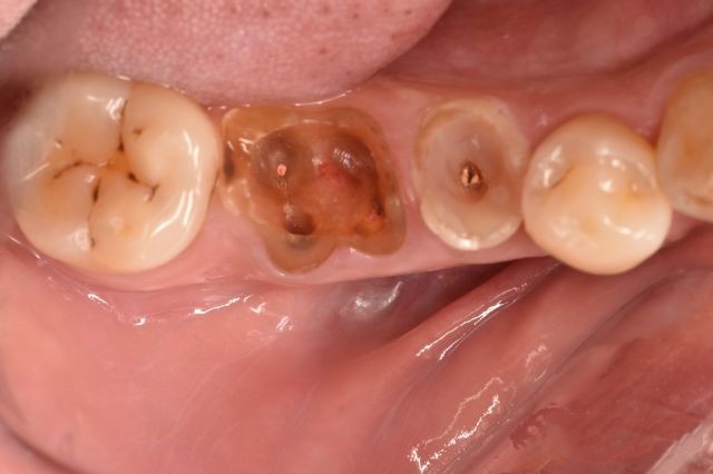 成人矫正期间牙齿松动正常吗,成年人牙齿矫正会松动吗